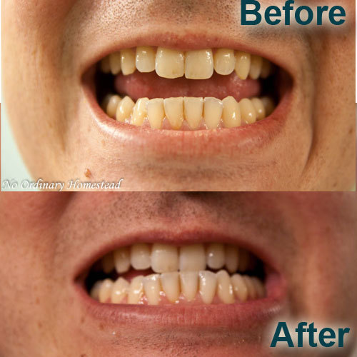 teeth-whitening-before-after