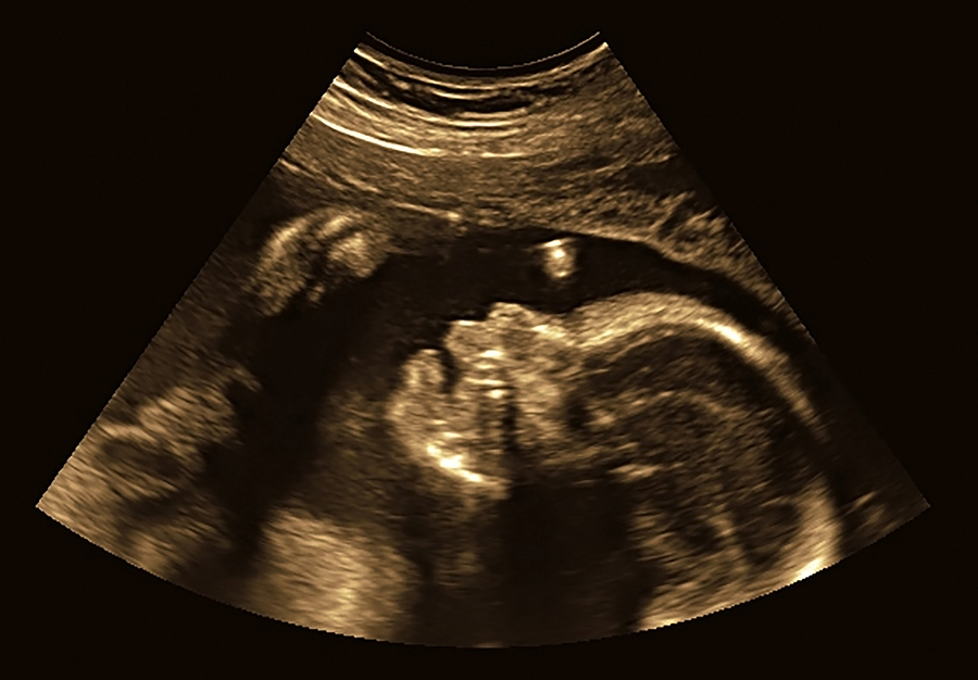 How to Cope with a Positive Prenatal Test Result